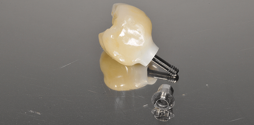 Parallelwandige Implantatkörper mit konischen Abutmentverbindungen