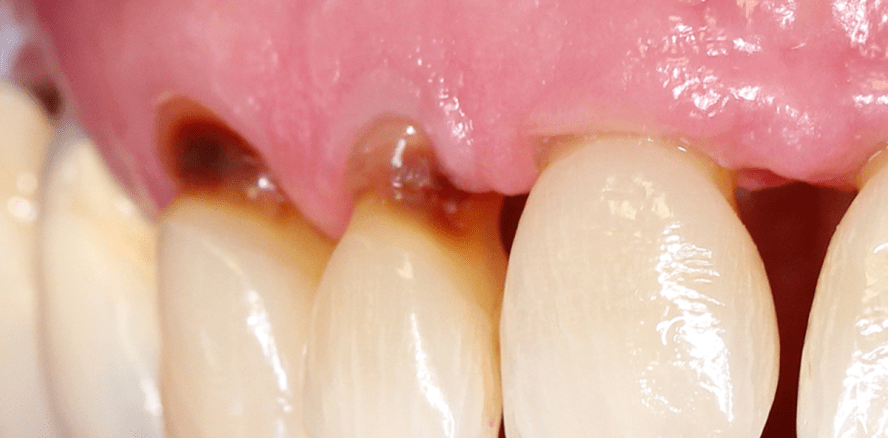 Mundtrockenheit – Teil 1: Prävalenz, Ursachen und Symptome