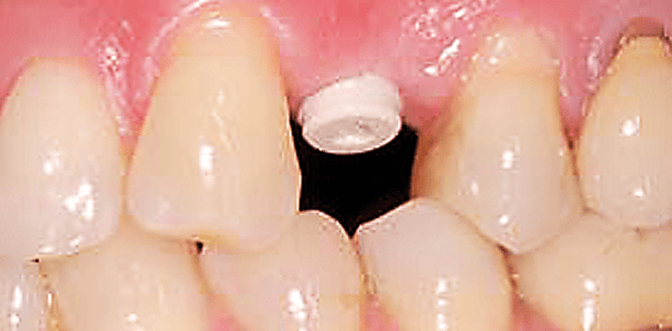 Keramikimplantate – eine Übersicht