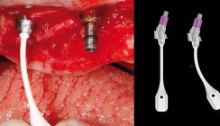 Sofortversorgung des zahnlosen Ober- und Unterkiefers