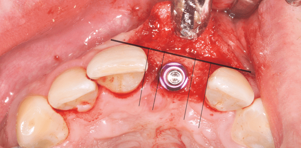 Ästhetische Implantatversorgung bei insuffizientem Kieferkammgewebe