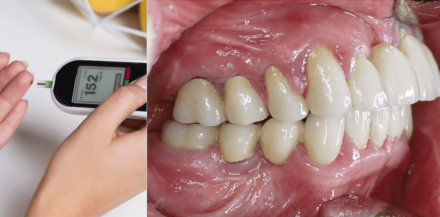 Auswirkungen der Assoziation ­zwischen Parodontitis und Diabetes in der Patientenberatung