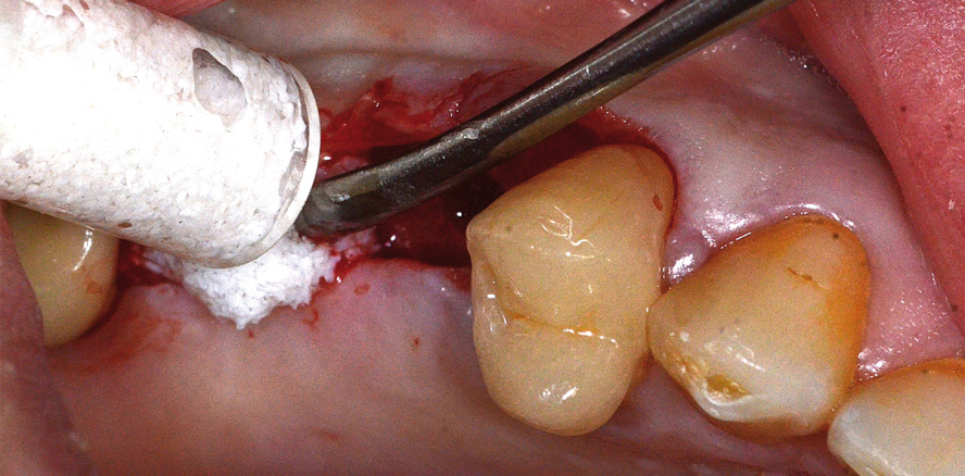 Basisaugmentation mit monophasischen Knochenkeramiken