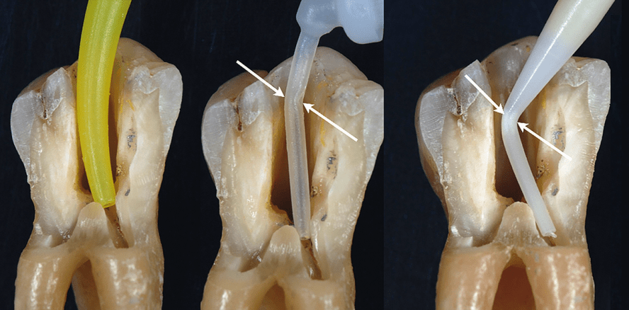 Neue Optionen für devitale Zähne: Das Colibri-Konzept