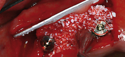Sichere Knochenregeneration durch neue Kollagenmembran