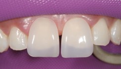 Lückenschluss mit dem Direct Composite Veneering System