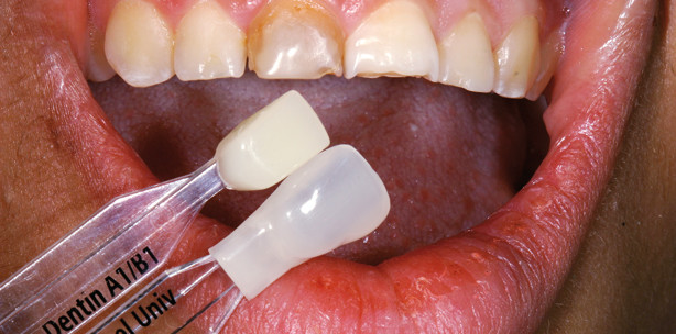 Praxisnahe Lösung ästhetisch kompromittierender Fälle