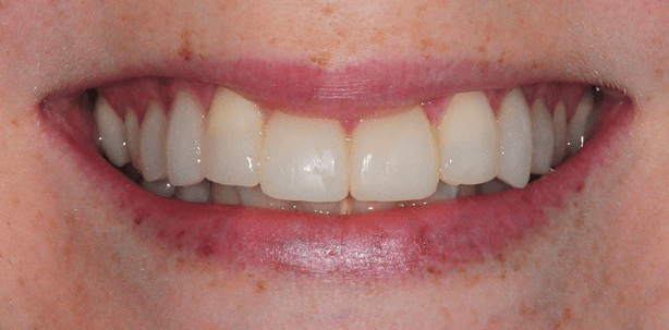 Kompositverblendschalen außer Konkurrenz