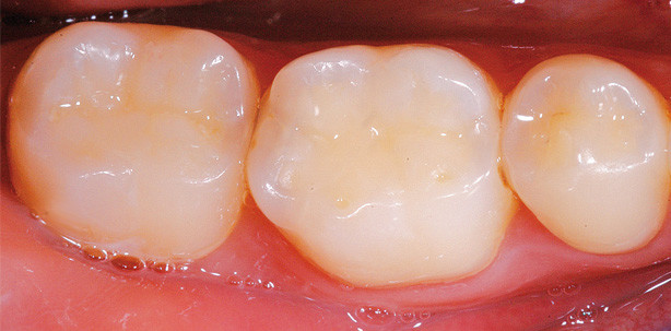 Composite-Restaurationen im Seitenzahnbereich