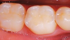 Composite-Restaurationen im Seitenzahnbereich