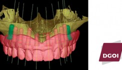 Moderne Implantatprothetik fordert fundiertes Wissen