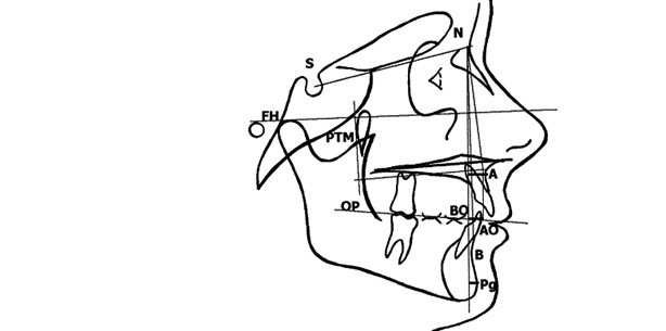 Cervical Vertebral Maturation (CVM)