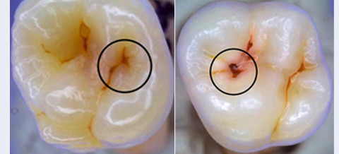 Das International Caries Detection and Assessment System (ICDAS-II)
