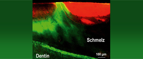 Mikroinvasive Therapie der initialen Karies