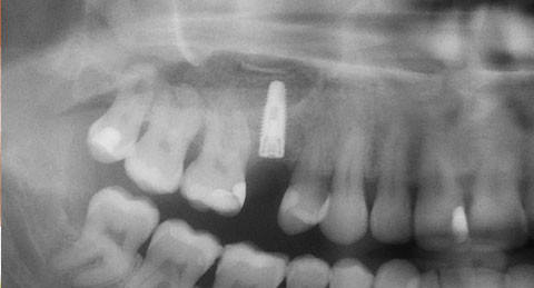 Der piezochirurgische Sinuslift  mit simultaner Implantation