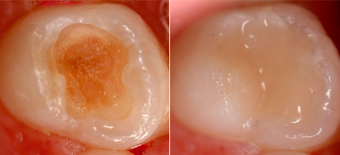 Milchzahnendodontie - eine Übersicht