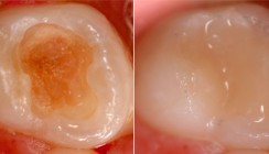 Milchzahnendodontie - eine Übersicht
