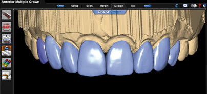 Digitale Abformung –  die Fakten und Vorteile