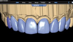 Digitale Abformung –  die Fakten und Vorteile