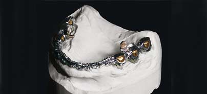 CAD/CAM-basierte Versorgung ­eines zahnlosen Oberkiefers