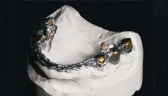 CAD/CAM-basierte Versorgung ­eines zahnlosen Oberkiefers