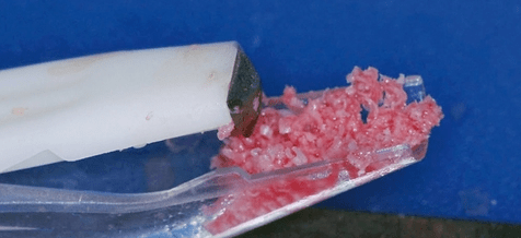 Knochendefizite  mit autologen Transplantaten ausgleichen