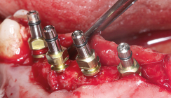 Konzept zur Versorgung eines Oberkiefers mit Indikationsklasse IIIa