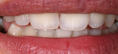 Farbsichere und wirkungsvolle Restaurationen