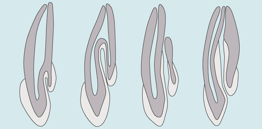 Diagnostik und Therapie eines Dens invaginatus