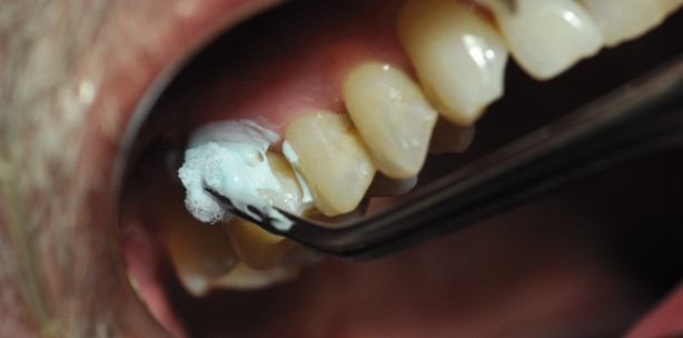 Schmerzempfindliche Zähne – eine Herausforderung für die Praxis