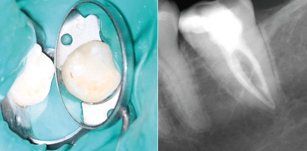 Der systematische Abschluss der „Endo“ durch die „Kons“