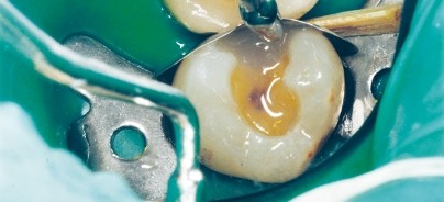 Füllungsmaterial für die Seitenzahnrestauration