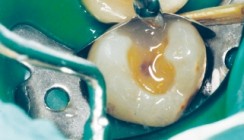 Füllungsmaterial für die Seitenzahnrestauration