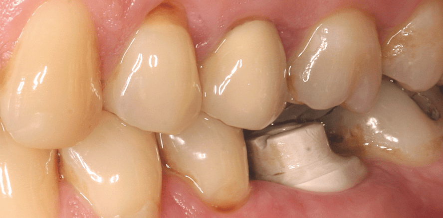 Prothetische Stützung des Weichgewebes bei ­Implantatfreilegung