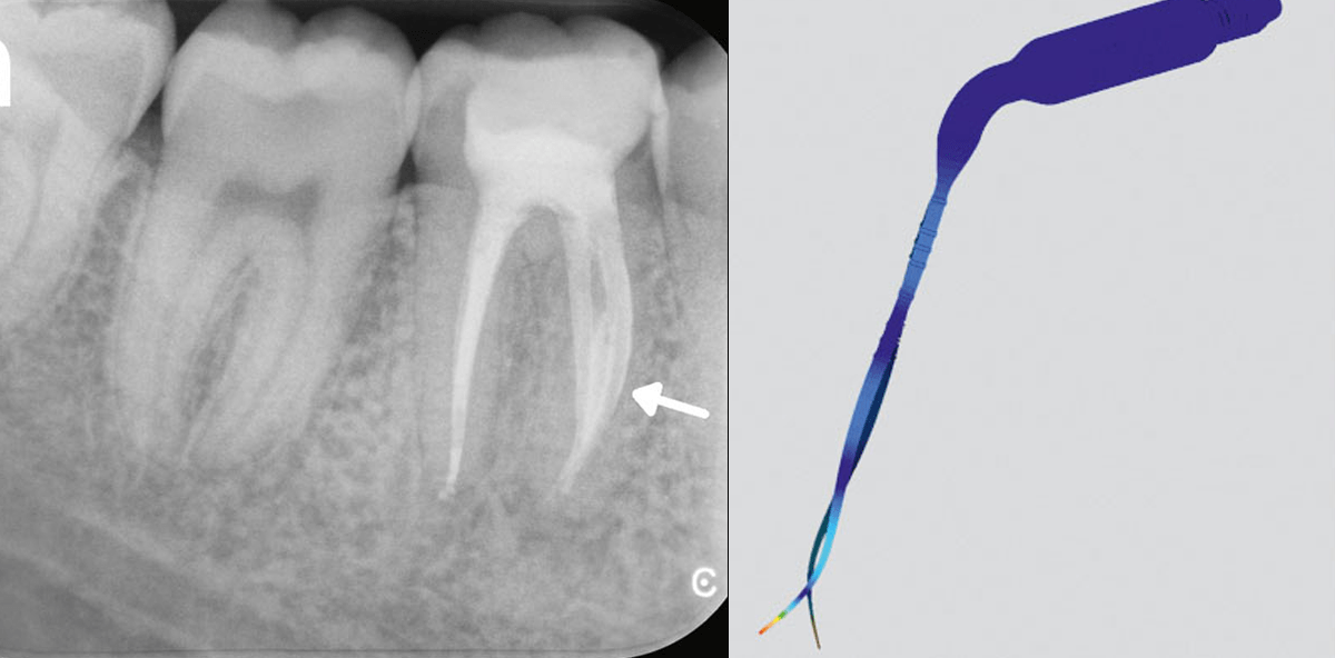 Vollständige chemomechanische Desinfektion des Wurzelkanalsystems