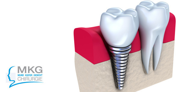 Zahnimplantate: heute so sicher wie nie