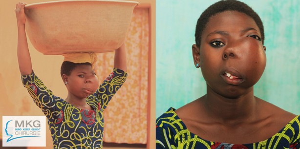 Mädchen in Togo von gefährlichem Gesichtstumor befreit