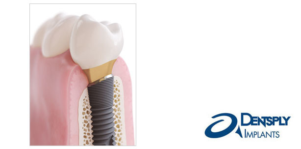 DENTSPLY Implants zeigt Profil: mit OsseoSpeed Profile EV