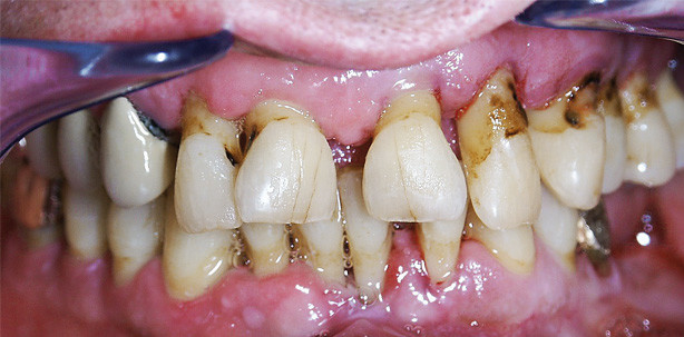 Diabetes mellitus und Parodontitis – eine Herausforderung