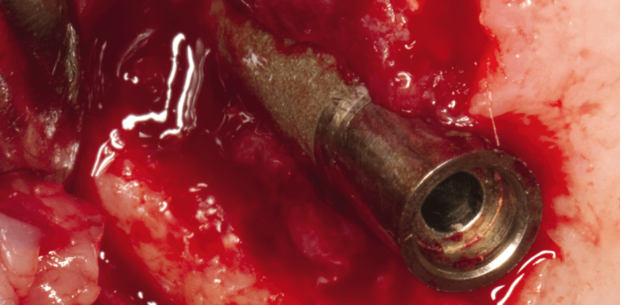 Diabetes mellitus in der Implantologie