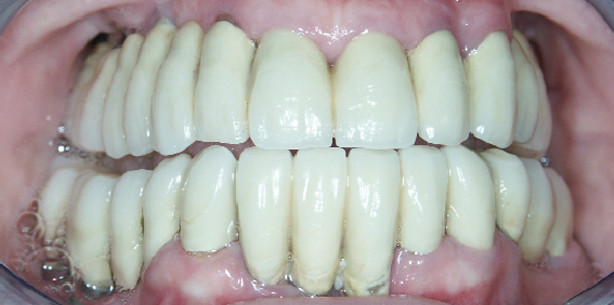 Diabetes und Implantate