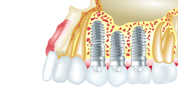 Studie: Diabetes hat keinen Einfluss auf den Implantaterfolg