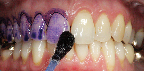 Die perfekte Prophylaxesitzung in 60 bis 70 Minuten