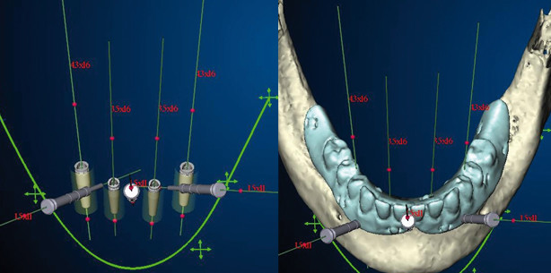 Computerassistierte Implantologie und Prothetik im Alter