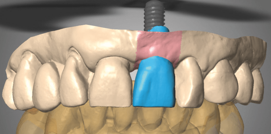 Management des supraimplantären Emergenzprofils im Zeitalter der digitalen Zahnmedizin