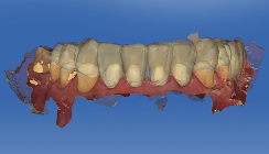 Vollvernetzter digitaler Workflow in der Implantattherapie