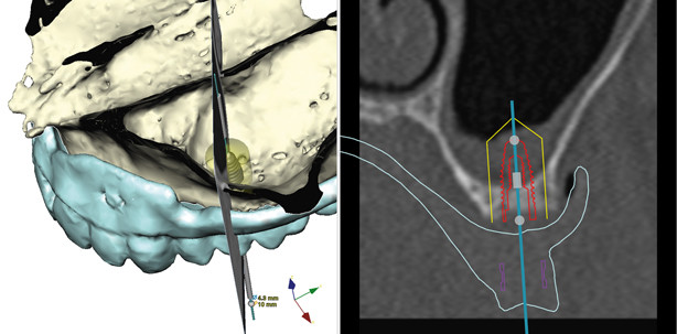 Fortschritte in der digitalen Implantatprothetik