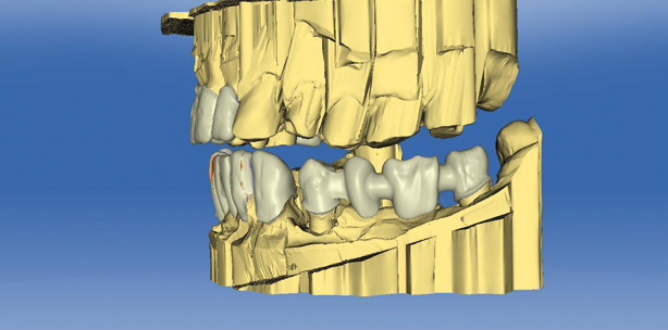 Wie digital ist die Zahntechnik wirklich?