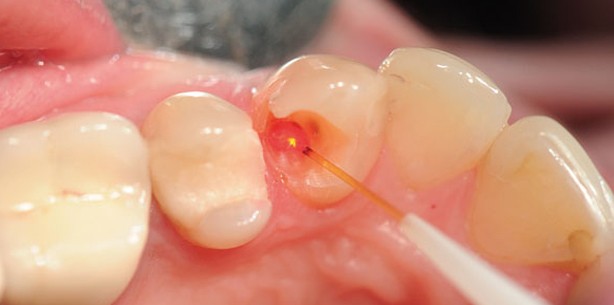 Diodenlaser unterstützt Vitalerhaltung der Pulpa bei Caries profunda
