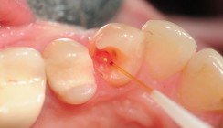 Diodenlaser unterstützt Vitalerhaltung der Pulpa bei Caries profunda